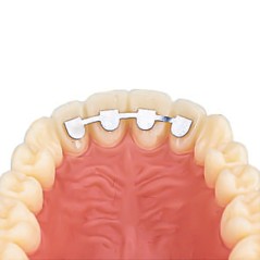 DB RETAINER KIT UPPER LAT/LAT